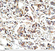 Immunohistochemical staining of STXBP3 using anti-STXBP3 antibody. STXBP3 was detected in a paraffin-embedded section of human breast cancer tissue. Heat mediated antigen retrieval was performed in EDTA buffer (pH 8.0, epitope retrieval solution). The tissue section was blocked with 10% goat serum. The tissue section was then incubated with 2 ug/ml rabbit anti-STXBP3 antibody overnight at 4oC. Peroxidase Conjugated Goat Anti-rabbit IgG was used as secondary antibody and incubated for 30 minutes at 37oC. The tissue section was developed using an HRP secondary and DAB substrate.