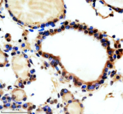 Immunohistochemical staining of TAOK2 using anti-TAOK2 antibody. TAOK2 was detected in a paraffin-embedded section of human thyroid cancer tissue. Heat mediated antigen retrieval was performed in EDTA buffer (pH 8.0, epitope retrieval solution). The tissue section was blocked with 10% goat serum. The tissue section was then incubated with 2 ug/ml rabbit anti-TAOK2 antibody overnight at 4oC. Peroxidase Conjugated Goat Anti-rabbit IgG was used as secondary antibody and incubated for 30 minutes at 37oC. The tissue section was developed using an HRP secondary and DAB substrate.