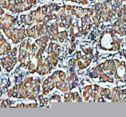 Immunohistochemical staining of PDZD8 using anti-PDZD8 antibody. PDZD8 was detected in a paraffin-embedded section of human liver cancer tissue. Heat mediated antigen retrieval was performed in EDTA buffer (pH 8.0, epitope retrieval solution). The tissue section was blocked with 10% goat serum. The tissue section was then incubated with 2 ug/ml rabbit anti-PDZD8 antibody overnight at 4oC. Peroxidase Conjugated Goat Anti-rabbit IgG was used as secondary antibody and incubated for 30 minutes at 37oC. The tissue section was developed using an HRP secondary and DAB substrate.