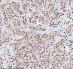 Immunohistochemical staining of MED4 using anti-MED4 antibody. MED4 was detected in a paraffin-embedded section of human breast cancer tissue. Heat mediated antigen retrieval was performed in EDTA buffer (pH 8.0, epitope retrieval solution). The tissue section was blocked with 10% goat serum. The tissue section was then incubated with 2 ug/ml rabbit anti-MED4 antibody overnight at 4oC. Peroxidase Conjugated Goat Anti-rabbit IgG was used as secondary antibody and incubated for 30 minutes at 37oC. The tissue section was developed using an HRP secondary and DAB substrate.