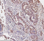 Immunohistochemical staining of MED4 using anti-MED4 antibody. MED4 was detected in a paraffin-embedded section of human rectum adenocarcinoma tissue. Heat mediated antigen retrieval was performed in EDTA buffer (pH 8.0, epitope retrieval solution). The tissue section was blocked with 10% goat serum. The tissue section was then incubated with 2 ug/ml rabbit anti-MED4 antibody overnight at 4oC. Peroxidase Conjugated Goat Anti-rabbit IgG was used as secondary antibody and incubated for 30 minutes at 37oC. The tissue section was developed using an HRP secondary and DAB substrate.
