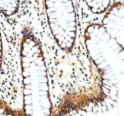 Immunohistochemical staining of NAV1 using anti-NAV1 antibody. NAV1 was detected in a paraffin-embedded section of human colon cancer tissue. Heat mediated antigen retrieval was performed in EDTA buffer (pH 8.0, epitope retrieval solution). The tissue section was blocked with 10% goat serum. The tissue section was then incubated with 2 ug/ml rabbit anti-NAV1 antibody overnight at 4oC. Peroxidase Conjugated Goat Anti-rabbit IgG was used as secondary antibody and incubated for 30 minutes at 37oC. The tissue section was developed using an HRP secondary and DAB substrate.
