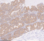 Immunohistochemical staining of COQ8B using anti-COQ8B antibody. COQ8B was detected in a paraffin-embedded section of human ovarian cancer tissue. Heat mediated antigen retrieval was performed in EDTA buffer (pH 8.0, epitope retrieval solution). The tissue section was blocked with 10% goat serum. The tissue section was then incubated with 2 ug/ml rabbit anti-COQ8B antibody overnight at 4oC. Peroxidase Conjugated Goat Anti-rabbit IgG was used as secondary antibody and incubated for 30 minutes at 37oC. The tissue section was developed using an HRP secondary and DAB substrate.