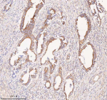 Immunohistochemical staining of COQ8B using anti-COQ8B antibody. COQ8B was detected in a paraffin-embedded section of human rectum adenocarcinoma tissue. Heat mediated antigen retrieval was performed in EDTA buffer (pH 8.0, epitope retrieval solution). The tissue section was blocked with 10% goat serum. The tissue section was then incubated with 2 ug/ml rabbit anti-COQ8B antibody overnight at 4oC. Peroxidase Conjugated Goat Anti-rabbit IgG was used as secondary antibody and incubated for 30 minutes at 37oC. The tissue section was developed using an HRP secondary and DAB substrate.