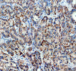 Immunohistochemical staining of TIMM50 using anti-TIMM50 antibody. TIMM50 was detected in a paraffin-embedded section of human liver cancer tissue. Heat mediated antigen retrieval was performed in EDTA buffer (pH 8.0, epitope retrieval solution). The tissue section was blocked with 10% goat serum. The tissue section was then incubated with 2 ug/ml rabbit anti-TIMM50 antibody overnight at 4oC. Peroxidase Conjugated Goat Anti-rabbit IgG was used as secondary antibody and incubated for 30 minutes at 37oC. The tissue section was developed using an HRP secondary and DAB substrate.
