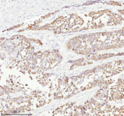 Immunohistochemical staining of RGL3 using anti-RGL3 antibody. RGL3 was detected in a paraffin-embedded section of human liver cancer tissue. Heat mediated antigen retrieval was performed in EDTA buffer (pH 8.0, epitope retrieval solution). The tissue section was blocked with 10% goat serum. The tissue section was then incubated with 2 ug/ml rabbit anti-RGL3 antibody overnight at 4oC. Peroxidase Conjugated Goat Anti-rabbit IgG was used as secondary antibody and incubated for 30 minutes at 37oC. The tissue section was developed using an HRP secondary and DAB substrate.