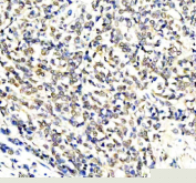 Immunohistochemical staining of RERE using anti-RERE antibody. RERE was detected in a paraffin-embedded section of human breast cancer tissue. Heat mediated antigen retrieval was performed in EDTA buffer (pH 8.0, epitope retrieval solution). The tissue section was blocked with 10% goat serum. The tissue section was then incubated with 2 ug/ml rabbit anti-RERE antibody overnight at 4oC. Peroxidase Conjugated Goat Anti-rabbit IgG was used as secondary antibody and incubated for 30 minutes at 37oC. The tissue section was developed using an HRP secondary and DAB substrate.