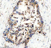 Immunohistochemical staining of UBE2W using anti-UBE2W antibody. UBE2W was detected in a paraffin-embedded section of human pancreas cancer tissue. Heat mediated antigen retrieval was performed in EDTA buffer (pH 8.0, epitope retrieval solution). The tissue section was blocked with 10% goat serum. The tissue section was then incubated with 2 ug/ml rabbit anti-UBE2W antibody overnight at 4oC. Peroxidase Conjugated Goat Anti-rabbit IgG was used as secondary antibody and incubated for 30 minutes at 37oC. The tissue section was developed using an HRP secondary and DAB substrate.