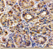 Immunohistochemical staining of UBE2W using anti-UBE2W antibody. UBE2W was detected in a paraffin-embedded section of human liver cancer tissue. Heat mediated antigen retrieval was performed in EDTA buffer (pH 8.0, epitope retrieval solution). The tissue section was blocked with 10% goat serum. The tissue section was then incubated with 2 ug/ml rabbit anti-UBE2W antibody overnight at 4oC. Peroxidase Conjugated Goat Anti-rabbit IgG was used as secondary antibody and incubated for 30 minutes at 37oC. The tissue section was developed using an HRP secondary and DAB substrate.