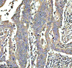 Immunohistochemical staining of GCNT2 using anti-GCNT2 antibody. GCNT2 was detected in a paraffin-embedded section of human colon cancer tissue. Heat mediated antigen retrieval was performed in EDTA buffer (pH 8.0, epitope retrieval solution). The tissue section was blocked with 10% goat serum. The tissue section was then incubated with 2 ug/ml rabbit anti-GCNT2 antibody overnight at 4oC. Peroxidase Conjugated Goat Anti-rabbit IgG was used as secondary antibody and incubated for 30 minutes at 37oC. The tissue section was developed using an HRP secondary and DAB substrate.