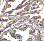 Immunohistochemical staining of GCNT2 using anti-GCNT2 antibody. GCNT2 was detected in a paraffin-embedded section of human prostate cancer tissue. Heat mediated antigen retrieval was performed in EDTA buffer (pH 8.0, epitope retrieval solution). The tissue section was blocked with 10% goat serum. The tissue section was then incubated with 2 ug/ml rabbit anti-GCNT2 antibody overnight at 4oC. Peroxidase Conjugated Goat Anti-rabbit IgG was used as secondary antibody and incubated for 30 minutes at 37oC. The tissue section was developed using an HRP secondary and DAB substrate.