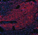 Immunofluorescent staining of GCNT2 using anti-GCNT2 antibody (red). GCNT2was detected in a paraffin-embedded section of human intestine cancer tissue. Heat mediated antigen retrieval was performed in EDTA buffer (pH 8.0, epitope retrieval solution). The tissue section was blocked with 10% goat serum. The tissue section was then incubated with 5 ug/ml rabbit anti-GCNT2 antibody overnight at 4oC. Cy3 Conjugated Goat Anti-Rabbit IgG was used as secondary antibody at 1:500 dilution and incubated for 30 minutes at 37oC. The section was counterstained with DAPI nuclear stain (blue). Visualize using a fluorescence microscope and filter sets appropriate for the label used.