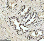 Immunohistochemical staining of EIF4A3 using anti-EIF4A3 antibody. EIF4A3 was detected in a paraffin-embedded section of human prostate cancer tissue. Heat mediated antigen retrieval was performed in EDTA buffer (pH 8.0, epitope retrieval solution). The tissue section was blocked with 10% goat serum. The tissue section was then incubated with 2 ug/ml rabbit anti-EIF4A3 antibody overnight at 4oC. Peroxidase Conjugated Goat Anti-rabbit IgG was used as secondary antibody and incubated for 30 minutes at 37oC. The tissue section was developed using an HRP secondary and DAB substrate.