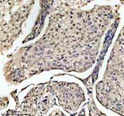 Immunohistochemical staining of EIF4A3 using anti-EIF4A3 antibody. EIF4A3 was detected in a paraffin-embedded section of human cervical cancer tissue. Heat mediated antigen retrieval was performed in EDTA buffer (pH 8.0, epitope retrieval solution). The tissue section was blocked with 10% goat serum. The tissue section was then incubated with 2 ug/ml rabbit anti-EIF4A3 antibody overnight at 4oC. Peroxidase Conjugated Goat Anti-rabbit IgG was used as secondary antibody and incubated for 30 minutes at 37oC. The tissue section was developed using an HRP secondary and DAB substrate.