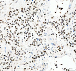 Immunohistochemical staining of PRDM11 using anti-PRDM11 antibody. PRDM11 was detected in a paraffin-embedded section of human lung cancer tissue. Heat mediated antigen retrieval was performed in EDTA buffer (pH 8.0, epitope retrieval solution). The tissue section was blocked with 10% goat serum. The tissue section was then incubated with 2 ug/ml rabbit anti-PRDM11 antibody overnight at 4oC. Peroxidase Conjugated Goat Anti-rabbit IgG was used as secondary antibody and incubated for 30 minutes at 37oC. The tissue section was developed using an HRP secondary and DAB substrate.