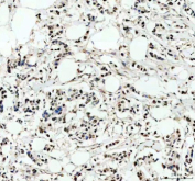 Immunohistochemical staining of PRDM11 using anti-PRDM11 antibody. PRDM11 was detected in a paraffin-embedded section of human breast cancer tissue. Heat mediated antigen retrieval was performed in EDTA buffer (pH 8.0, epitope retrieval solution). The tissue section was blocked with 10% goat serum. The tissue section was then incubated with 2 ug/ml rabbit anti-PRDM11 antibody overnight at 4oC. Peroxidase Conjugated Goat Anti-rabbit IgG was used as secondary antibody and incubated for 30 minutes at 37oC. The tissue section was developed using an HRP secondary and DAB substrate.