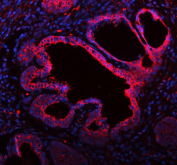 Immunofluorescent staining of FFPE human prostate cancer tissue with ME3 antibody (red) and DAPI nuclear stain (blue). HIER: steam section in pH8 EDTA buffer for 20 min.
