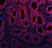 Immunofluorescent staining of FFPE human colon cancer tissue with ME3 antibody (red) and DAPI nuclear stain (blue). HIER: steam section in pH8 EDTA buffer for 20 min.