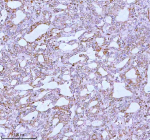 Immunohistochemical staining of using anti-ME3 antibody. ME3 was detected in a paraffin-embedded section of human prostate adenocarcinoma tissue. Heat mediated antigen retrieval was performed in EDTA buffer (pH 8.0, epitope retrieval solution). The tissue section was blocked with 10% goat serum. The tissue section was then incubated with 2 ug/ml rabbit anti-ME3 antibody overnight at 4oC. Peroxidase Conjugated Goat Anti-rabbit IgG was used as secondary antibody and incubated for 30 minutes at 37oC. The tissue section was developed using an HRP secondary and DAB substrate.