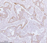 Immunohistochemical staining of using anti-ME3 antibody. ME3 was detected in a paraffin-embedded section of human rectum adenocarcinoma tissue. Heat mediated antigen retrieval was performed in EDTA buffer (pH 8.0, epitope retrieval solution). The tissue section was blocked with 10% goat serum. The tissue section was then incubated with 2 ug/ml rabbit anti-ME3 antibody overnight at 4oC. Peroxidase Conjugated Goat Anti-rabbit IgG was used as secondary antibody and incubated for 30 minutes at 37oC. The tissue section was developed using an HRP secondary and DAB substrate.