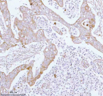 Immunohistochemical staining of using anti-ME3 antibody. ME3 was detected in a paraffin-embedded section of human rectum adenocarcinoma tissue. Heat mediated antigen retrieval was performed in EDTA buffer (pH 8.0, epitope retrieval solution). The tissue section was blocked with 10% goat serum. The tissue section was then incubated with 2 ug/ml rabbit anti-ME3 antibody overnight at 4oC. Peroxidase Conjugated Goat Anti-rabbit IgG was used as secondary antibody and incubated for 30 minutes at 37oC. The tissue section was developed using an HRP secondary and DAB substrate.