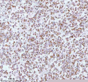 Immunohistochemical staining of using anti-ME3 antibody. ME3 was detected in a paraffin-embedded section of human testicular seminoma tissue. Heat mediated antigen retrieval was performed in EDTA buffer (pH 8.0, epitope retrieval solution). The tissue section was blocked with 10% goat serum. The tissue section was then incubated with 2 ug/ml rabbit anti-ME3 antibody overnight at 4oC. Peroxidase Conjugated Goat Anti-rabbit IgG was used as secondary antibody and incubated for 30 minutes at 37oC. The tissue section was developed using an HRP secondary and DAB substrate.