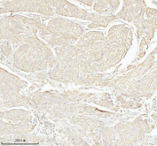 Immunohistochemical staining of TAS2R10 using anti-TAS2R10 antibody. TAS2R10 was detected in a paraffin-embedded section of human cervix squamous cell carcinoma tissue. Heat mediated antigen retrieval was performed in EDTA buffer (pH 8.0, epitope retrieval solution). The tissue section was blocked with 10% goat serum. The tissue section was then incubated with 2 ug/ml rabbit anti-TAS2R10 antibody overnight at 4oC. Peroxidase Conjugated Goat Anti-rabbit IgG was used as secondary antibody and incubated for 30 minutes at 37oC. The tissue section was developed using an HRP secondary and DAB substrate.