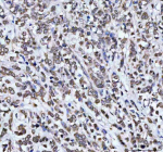 Immunohistochemical staining of AHCY using anti-AHCY antibody. AHCY was detected in a paraffin-embedded section of human breast cancer tissue. Heat mediated antigen retrieval was performed in EDTA buffer (pH 8.0, epitope retrieval solution). The tissue section was blocked with 10% goat serum. The tissue section was then incubated with 2 ug/ml rabbit anti-AHCY antibody overnight at 4oC. Peroxidase Conjugated Goat Anti-rabbit IgG was used as secondary antibody and incubated for 30 minutes at 37oC. The tissue section was developed using an HRP secondary and DAB substrate.