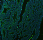Immunofluorescent staining of MATK using anti-MATK antibody (green). MATK was detected in a paraffin-embedded section of human colon cancer tissue. Heat mediated antigen retrieval was performed in EDTA buffer (pH 8.0, epitope retrieval solution). The tissue section was blocked with 10% goat serum. The tissue section was then incubated with 5 ug/ml rabbit anti-MATK antibody overnight at 4oC. DyLight 488 Conjugated Goat Anti-Rabbit IgG was used as secondary antibody at 1:500 dilution and incubated for 30 minutes at 37oC. The section was counterstained with DAPI nuclear stain (blue). Visualize using a fluorescence microscope and filter sets appropriate for the label used.