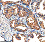 Immunohistochemical staining of NUDT8 using anti-NUDT8 antibody. NUDT8 was detected in a paraffin-embedded section of human prostatic hyperplasia tissue. Heat mediated antigen retrieval was performed in EDTA buffer (pH 8.0, epitope retrieval solution). The tissue section was blocked with 10% goat serum. The tissue section was then incubated with 2 ug/ml rabbit anti-NUDT8 antibody overnight at 4oC. Peroxidase Conjugated Goat Anti-rabbit IgG was used as secondary antibody and incubated for 30 minutes at 37oC. The tissue section was developed using an HRP secondary and DAB substrate.