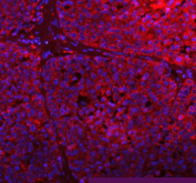 Immunofluorescent staining of GCLC using anti-GCLC antibody (red). GCLC was detected in a paraffin-embedded section of human liver cancer tissue. Heat mediated antigen retrieval was performed in EDTA buffer (pH 8.0, epitope retrieval solution). The tissue section was blocked with 10% goat serum. The tissue section was then incubated with 5 ug/ml rabbit anti-GCLC antibody overnight at 4oC. DyLight 594 Conjugated Goat Anti-Rabbit IgG was used as secondary antibody at 1:500 dilution and incubated for 30 minutes at 37oC. The section was counterstained with DAPI nuclear stain (blue). Visualize using a fluorescence microscope and filter sets appropriate for the label used.