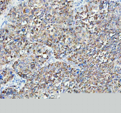 Immunohistochemical staining of FFPE human liver cancer tissue with ACOX1 antibody, HRP-secondary and DAB substrate. HIER: boil tissue sections in pH8 EDTA for 20 min and allow to cool before testing.