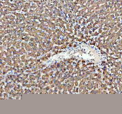 Immunohistochemical staining of FFPE human liver cancer tissue with ACOX1 antibody, HRP-secondary and DAB substrate. HIER: boil tissue sections in pH8 EDTA for 20 min and allow to cool before testing.