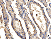 Immunohistochemical staining of FFPE human liver cancer tissue with SRP72 antibody, HRP-secondary and DAB substrate. HIER: boil tissue sections in pH8 EDTA for 20 min and allow to cool before testing.
