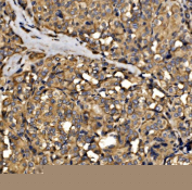 Immunohistochemical staining of FFPE human thyroid cancer tissue with SRP72 antibody, HRP-secondary and DAB substrate. HIER: boil tissue sections in pH8 EDTA for 20 min and allow to cool before testing.