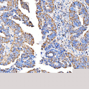 Immunohistochemical staining of FFPE human rectum adenocarcinoma tissue with SUCLG2 antibody, HRP-secondary and DAB substrate. HIER: boil tissue sections in pH8 EDTA for 20 min and allow to cool before testing.