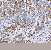 Immunohistochemical staining of FFPE human prostate adenocarcinoma tissue with SUCLG2 antibody, HRP-secondary and DAB substrate. HIER: boil tissue sections in pH8 EDTA for 20 min and allow to cool before testing.