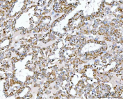 Immunohistochemical staining of FFPE human thyroid papillary carcinoma tissue with SUCLG2 antibody, HRP-secondary and DAB substrate. HIER: boil tissue sections in pH8 EDTA for 20 min and allow to cool before testing.