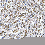 Immunohistochemical staining of FFPE human breast cancer tissue with SUCLG2 antibody, HRP-secondary and DAB substrate. HIER: boil tissue sections in pH8 EDTA for 20 min and allow to cool before testing.