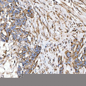 Immunohistochemical staining of FFPE human ovarian serous adenocarcinoma tissue with SUCLG2 antibody, HRP-secondary and DAB substrate. HIER: boil tissue sections in pH8 EDTA for 20 min and allow to cool before testing.