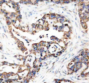 Immunohistochemical staining of FFPE human pancreas cancer tissue with Sonic Hedgehog antibody, HRP-secondary and DAB substrate. HIER: boil tissue sections in pH8 EDTA for 20 min and allow to cool before testing.