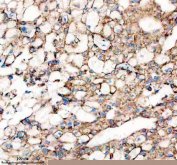 Immunohistochemical staining of FFPE human liver cancer tissue with Sonic Hedgehog antibody, HRP-secondary and DAB substrate. HIER: boil tissue sections in pH8 EDTA for 20 min and allow to cool before testing.