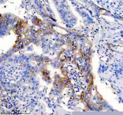Immunohistochemical staining of FFPE human colon cancer tissue with NCAM-L1 antibody, HRP-secondary and DAB substrate. HIER: boil tissue sections in pH8 EDTA for 20 min and allow to cool before testing.