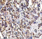 Immunohistochemical staining of FFPE human ovarian cancer tissue with ERCC2 antibody, HRP-secondary and DAB substrate. HIER: boil tissue sections in pH8 EDTA for 20 min and allow to cool before testing.