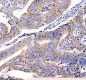 Immunohistochemical staining of FFPE human colon cancer tissue with USP14 antibody, HRP-secondary and DAB substrate. HIER: boil tissue sections in pH8 EDTA for 20 min and allow to cool before testing.