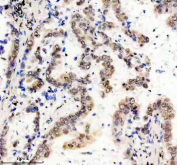 Immunohistochemical analysis of FTO using anti-FTO antibody. FTO is detected in a paraffin-embedded section of human lung cancer tissue following heat-mediated antigen retrieval in EDTA buffer (pH 8.0). Positive cell-associated staining is observed in tumor cells, consistent with reported FTO expression patterns.