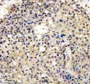 Immunohistochemical staining of FFPE human liver cancer tissue with FTO antibody, HRP-secondary and DAB substrate. HIER: boil tissue sections in pH8 EDTA for 20 min and allow to cool before testing.