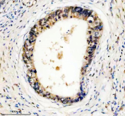 Immunohistochemical staining of FFPE human pancreas cancer tissue with FTO antibody, HRP-secondary and DAB substrate. HIER: boil tissue sections in pH8 EDTA for 20 min and allow to cool before testing.