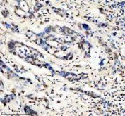 Immunohistochemical staining of FFPE human pancreas cancer tissue with FTO antibody, HRP-secondary and DAB substrate. HIER: boil tissue sections in pH8 EDTA for 20 min and allow to cool before testing.