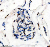 Immunohistochemical staining of FFPE human breast cancer tissue with FTO antibody, HRP-secondary and DAB substrate. HIER: boil tissue sections in pH8 EDTA for 20 min and allow to cool before testing.